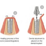 Guide To Dental-implants