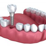 Lower teeth dental implant