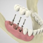 Dental implant procedure