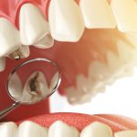 How to Clean Dentures and Avoid Bacteria