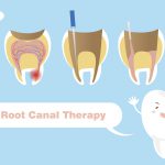 Root canal therapy