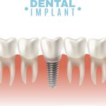 Dental Implant