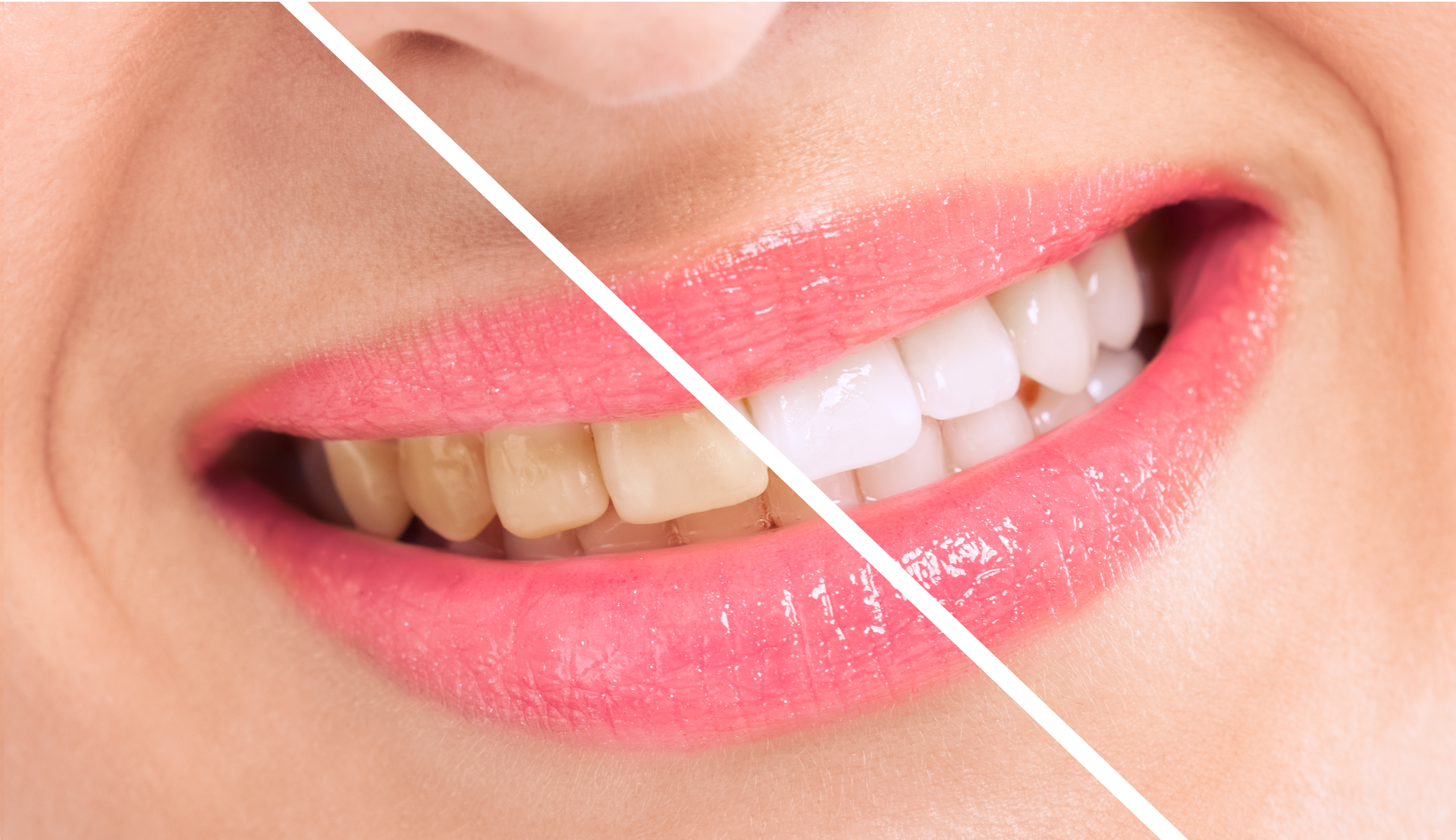 teeth whitening procedure