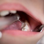 dental cavities