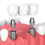 mini dental implants