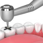 amalgam fillings