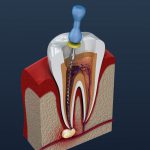 Dental Abscess