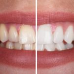 Pola Teeth Whitening