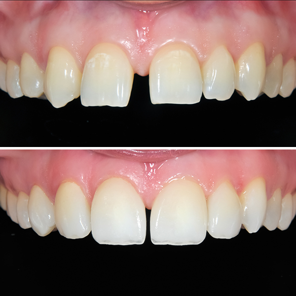 Tooth gap before and after