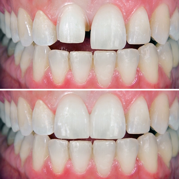 Dental Gap before and after