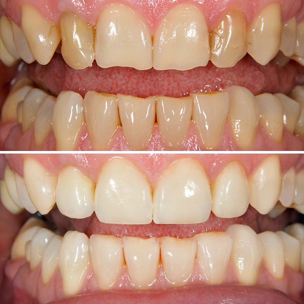 Before and After Crooked Teeth