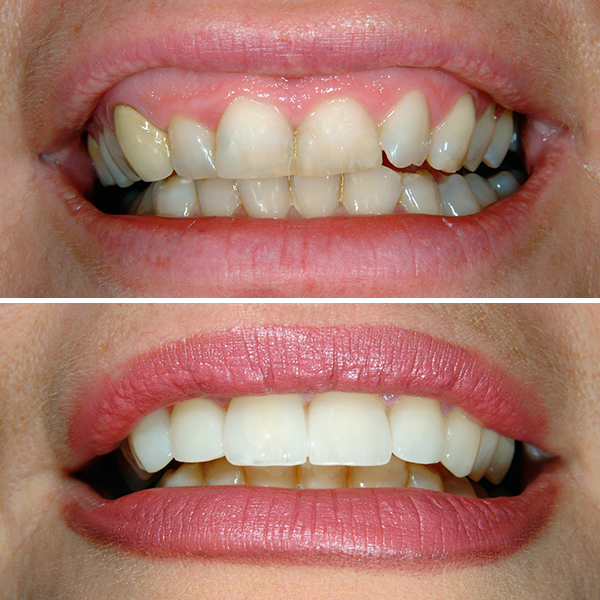 Dental veneers before and after