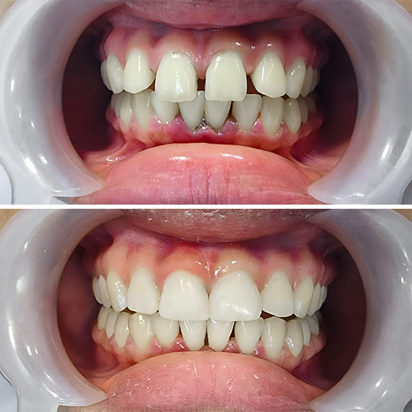 Teeth gap before and after