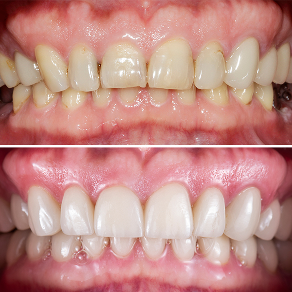 before and after veneers