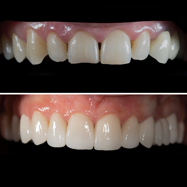 Crooked teeth before and after